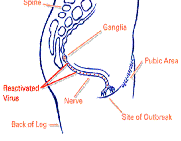 Primary Genital Herpes